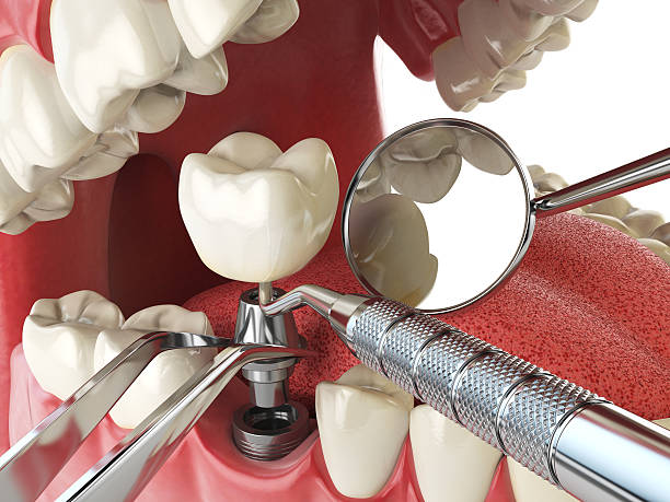 Best Emergency Tooth Extraction in Wilderness Rim, WA